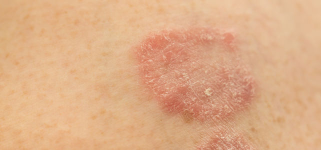 Upadacitinib provides fast onset of improvement in psoriatic arthritis